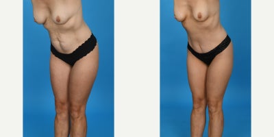 Case: 10624 - before and after photo of 35-44 year old woman treated with Abdominal Etching, Diastasis Recti Repair, Drainless Tummy Tuck, Liposculpture, Liposuction, M by John L. Burns Jr., MD
