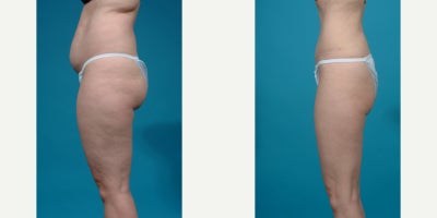 Case 10627 - 25-34 year old woman treated with Abdominal Etching, Diastasis Recti Repair, Drainless Tummy Tuck, Liposculpture, Liposuction, M