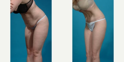 Case 10628 - 25-34 year old woman treated with Abdominal Etching, Diastasis Recti Repair, Drainless Tummy Tuck, Liposculpture, Liposuction, M