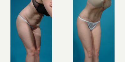 Case 10631 - 25-34 year old woman treated with Abdominal Etching, Diastasis Recti Repair, Drainless Tummy Tuck, Liposculpture, Liposuction, M