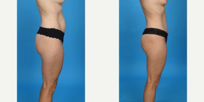 Case 10634 - 35-44 year old woman treated with Abdominal Etching, Diastasis Recti Repair, Drainless Tummy Tuck, Liposculpture, Liposuction, M