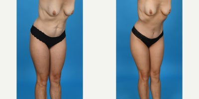 Case 10635 - 35-44 year old woman treated with Abdominal Etching, Diastasis Recti Repair, Drainless Tummy Tuck, Liposculpture, Liposuction, M