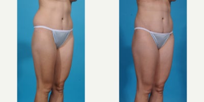 Case 10637 - 35-44 year old woman treated with Liposuction, Vaser Liposuction, Laser Liposuction, Smart Lipo, SlimLipo, Abdominal Etching, Tu