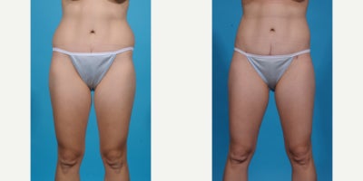 Case 10638 - 35-44 year old woman treated with Liposuction, Vaser Liposuction, Laser Liposuction, Smart Lipo, SlimLipo, Abdominal Etching, Tu