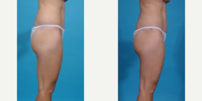 Case 10639 - 35-44 year old woman treated with Liposuction, Vaser Liposuction, Laser Liposuction, Smart Lipo, SlimLipo, Abdominal Etching, Tu