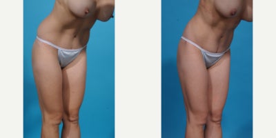 Case 10640 - 35-44 year old woman treated with Liposuction, Vaser Liposuction, Laser Liposuction, Smart Lipo, SlimLipo, Abdominal Etching, Tu