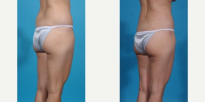 Case 10641 - 35-44 year old woman treated with Liposuction, Vaser Liposuction, Laser Liposuction, Smart Lipo, SlimLipo, Abdominal Etching, Tu