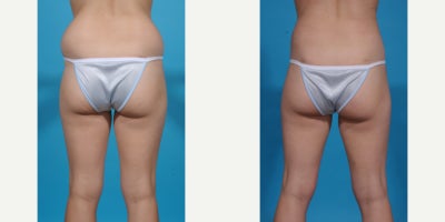 Case 10643 - 35-44 year old woman treated with Liposuction, Vaser Liposuction, Laser Liposuction, Smart Lipo, SlimLipo, Abdominal Etching, Tu