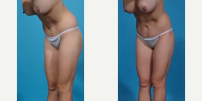 Case 10644 - 35-44 year old woman treated with Liposuction, Vaser Liposuction, Laser Liposuction, Smart Lipo, SlimLipo, Abdominal Etching, Tu