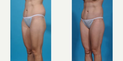 Case 10645 - 35-44 year old woman treated with Liposuction, Vaser Liposuction, Laser Liposuction, Smart Lipo, SlimLipo, Abdominal Etching, Tu