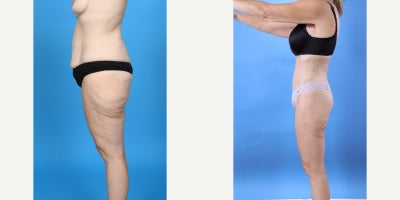 Case 10646 - 35-44 year old woman treated with Abdominal Etching, Tummy Tuck, Liposculpture, Mommy Makeover, Panniculectomy, Tumescent Liposu