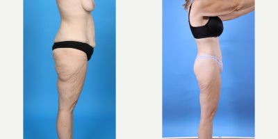 Case 10647 - 35-44 year old woman treated with Abdominal Etching, Tummy Tuck, Liposculpture, Mommy Makeover, Panniculectomy, Tumescent Liposu