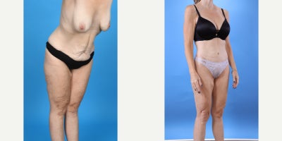 Case 10650 - 35-44 year old woman treated with Abdominal Etching, Tummy Tuck, Liposculpture, Mommy Makeover, Panniculectomy, Tumescent Liposu