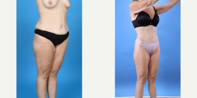 Case 10651 - 35-44 year old woman treated with Abdominal Etching, Tummy Tuck, Liposculpture, Mommy Makeover, Panniculectomy, Tumescent Liposu