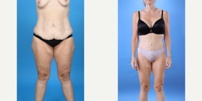 Case 10652 - 35-44 year old woman treated with Abdominal Etching, Tummy Tuck, Liposculpture, Mommy Makeover, Panniculectomy, Tumescent Liposu