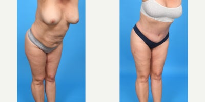 Case 10653 - 35-44 year old woman treated with Abdominal Etching, Diastasis Recti Repair, Drainless Tummy Tuck, Liposculpture, Liposuction, M