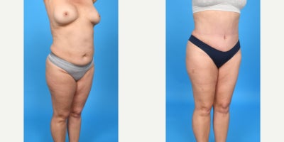 Case 10654 - 35-44 year old woman treated with Abdominal Etching, Diastasis Recti Repair, Drainless Tummy Tuck, Liposculpture, Liposuction, M