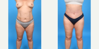 Case 10655 - 35-44 year old woman treated with Abdominal Etching, Diastasis Recti Repair, Drainless Tummy Tuck, Liposculpture, Liposuction, M