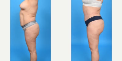 Case 10656 - 35-44 year old woman treated with Abdominal Etching, Diastasis Recti Repair, Drainless Tummy Tuck, Liposculpture, Liposuction, M