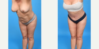 Case 10657 - 35-44 year old woman treated with Abdominal Etching, Diastasis Recti Repair, Drainless Tummy Tuck, Liposculpture, Liposuction, M