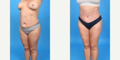 Case 10658 - 35-44 year old woman treated with Abdominal Etching, Diastasis Recti Repair, Drainless Tummy Tuck, Liposculpture, Liposuction, M