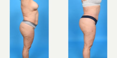 Case 10659 - 35-44 year old woman treated with Abdominal Etching, Diastasis Recti Repair, Drainless Tummy Tuck, Liposculpture, Liposuction, M