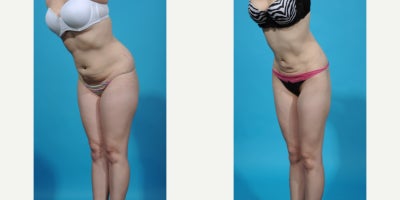 Case 10661 - 35-44 year old woman treated with Abdominal Etching, Laser Liposuction, Liposculpture, Liposuction, Power-Assisted Liposuction (