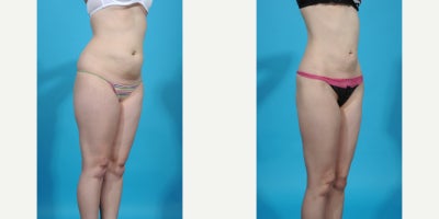 Case 10662 - 35-44 year old woman treated with Abdominal Etching, Laser Liposuction, Liposculpture, Liposuction, Power-Assisted Liposuction (