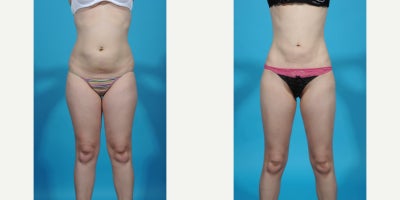 Case 10664 - 35-44 year old woman treated with Abdominal Etching, Laser Liposuction, Liposculpture, Liposuction, Power-Assisted Liposuction (