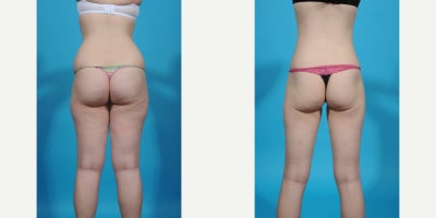 Case 10665 - 35-44 year old woman treated with Abdominal Etching, Laser Liposuction, Liposculpture, Liposuction, Power-Assisted Liposuction (