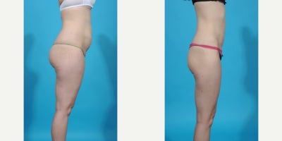 Case 10666 - 35-44 year old woman treated with Abdominal Etching, Laser Liposuction, Liposculpture, Liposuction, Power-Assisted Liposuction (