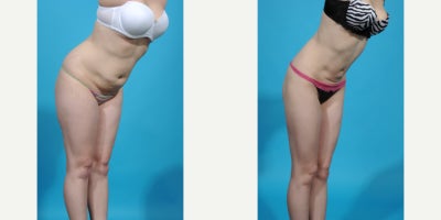 Case 10667 - 35-44 year old woman treated with Abdominal Etching, Laser Liposuction, Liposculpture, Liposuction, Power-Assisted Liposuction (