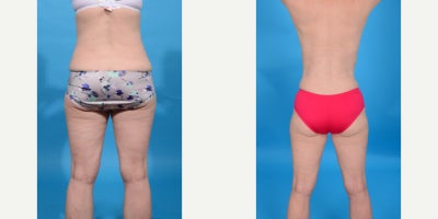 Case 10668 - 45-54 year old woman treated with Abdominal Etching, Diastasis Recti Repair, Drainless Tummy Tuck, Liposculpture, Liposuction, M