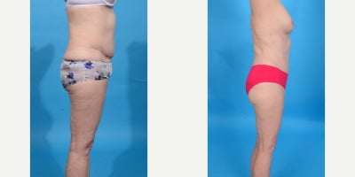 Case 10669 - 45-54 year old woman treated with Abdominal Etching, Diastasis Recti Repair, Drainless Tummy Tuck, Liposculpture, Liposuction, M