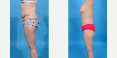 Case 10670 - 45-54 year old woman treated with Abdominal Etching, Diastasis Recti Repair, Drainless Tummy Tuck, Liposculpture, Liposuction, M