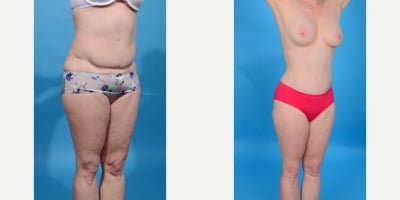 Case 10671 - 45-54 year old woman treated with Abdominal Etching, Diastasis Recti Repair, Drainless Tummy Tuck, Liposculpture, Liposuction, M