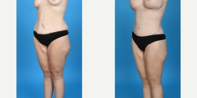 Case 10674 - 35-44 year old woman treated with Abdominal Etching, Body Lift, Diastasis Recti Repair, Drainless Tummy Tuck, Liposculpture, Lip