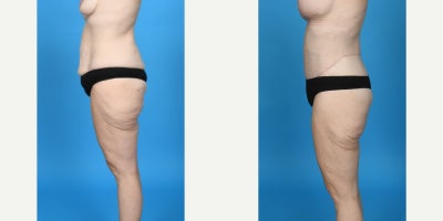 Case 10679 - 35-44 year old woman treated with Abdominal Etching, Body Lift, Diastasis Recti Repair, Drainless Tummy Tuck, Liposculpture, Lip