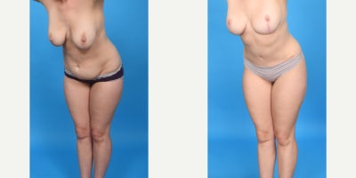 Case 10681 - 35-44 year old woman treated with Abdominal Etching, Diastasis Recti Repair, Drainless Tummy Tuck, Liposculpture, Liposuction, M