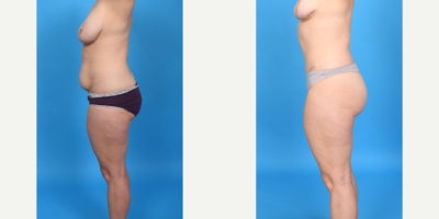 Case 10683 - 35-44 year old woman treated with Abdominal Etching, Diastasis Recti Repair, Drainless Tummy Tuck, Liposculpture, Liposuction, M