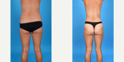 Case 10688 - 35-44 year old woman treated with Abdominal Etching, Diastasis Recti Repair, Drainless Tummy Tuck, Liposculpture, Liposuction, M