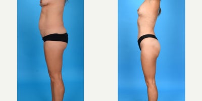 Case 10689 - 35-44 year old woman treated with Abdominal Etching, Diastasis Recti Repair, Drainless Tummy Tuck, Liposculpture, Liposuction, M