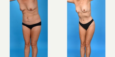 Case 10691 - 35-44 year old woman treated with Abdominal Etching, Diastasis Recti Repair, Drainless Tummy Tuck, Liposculpture, Liposuction, M