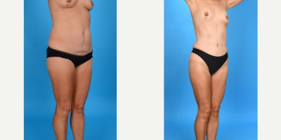 Case 10694 - 35-44 year old woman treated with Abdominal Etching, Diastasis Recti Repair, Drainless Tummy Tuck, Liposculpture, Liposuction, M