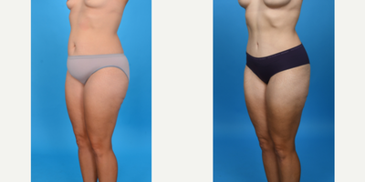 Case 10695 - 35-44 year old woman treated with Abdominal Etching, Diastasis Recti Repair, Drainless Tummy Tuck, Liposculpture, Liposuction, M