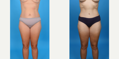 Case 10699 - 35-44 year old woman treated with Abdominal Etching, Diastasis Recti Repair, Drainless Tummy Tuck, Liposculpture, Liposuction, M