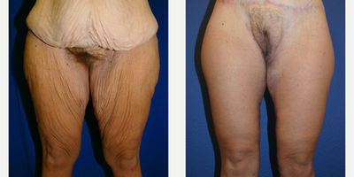 Case 107 - Woman treated with Tummy Tuck