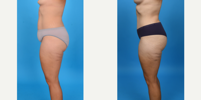 Case 10700 - 35-44 year old woman treated with Abdominal Etching, Diastasis Recti Repair, Drainless Tummy Tuck, Liposculpture, Liposuction, M