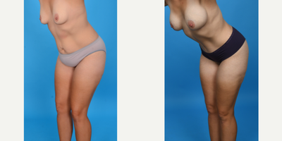 Case 10701 - 35-44 year old woman treated with Abdominal Etching, Diastasis Recti Repair, Drainless Tummy Tuck, Liposculpture, Liposuction, M