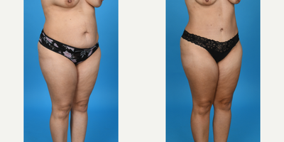 Case 10704 - 35-44 year old woman treated with Abdominal Etching, Diastasis Recti Repair, Drainless Tummy Tuck, Liposculpture, Liposuction, T